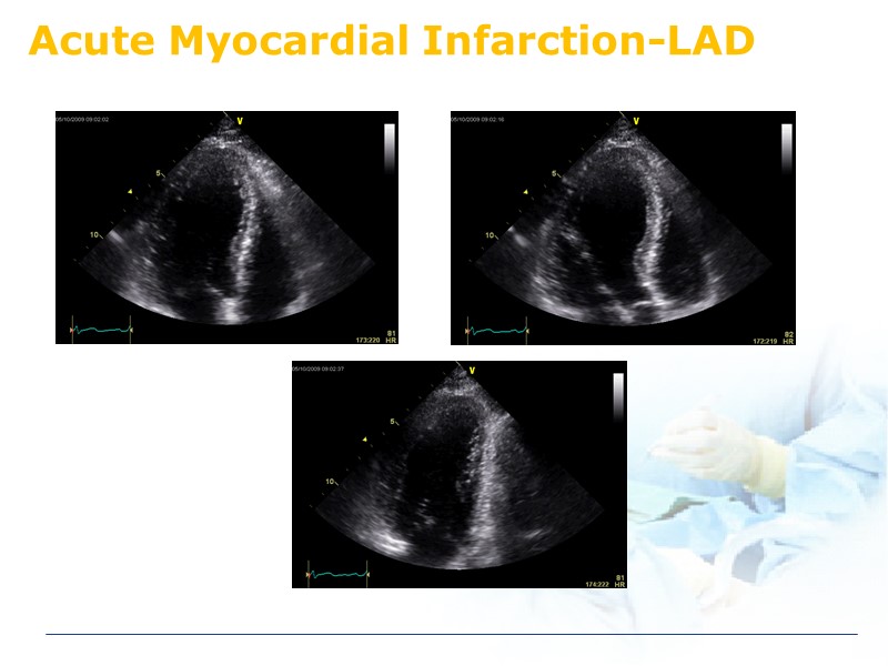 Acute Myocardial Infarction-LAD